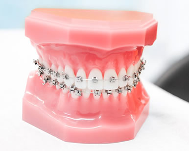 Are There Clear Braces Options? - Brimhall Dental Group Bakersfield  California