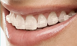 Ceramic Braces  Clear Orthodontic Options