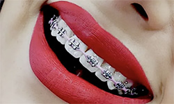 metal braces