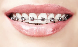 self-ligating braces