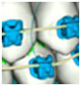 Braces on 3D Computer Model of Teeth